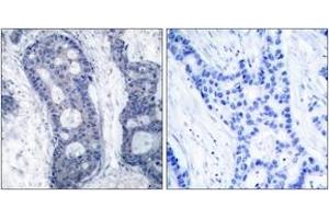 Immunohistochemistry analysis of paraffin-embedded human breast carcinoma tissue, using eIF4E (Ab-209) Antibody. (EIF4E 抗体  (AA 168-217))