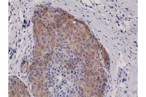 Immunohistochemical staining (Formalin-fixed paraffin-embedded sections) of human breast cancer with ACACA/ACACB (phospho S79) monoclonal antibody, clone RM270 . (Acetyl-CoA Carboxylase alpha 抗体  (pSer79))