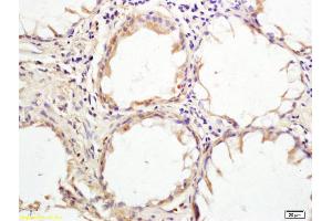 Formalin-fixed and paraffin embedded human rectal carcinoma tissue labeled with Anti HHLA2 Polyclonal Antibody, Unconjugated (ABIN1388019) at 1:200 followed by conjugation to the secondary antibody and DAB staining (HHLA2 抗体  (AA 231-330))