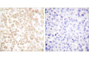 Peptide - +Immunohistochemical analysis of paraffin-embedded human breast carcinoma tissue using Fra-2 antibody (#C0197). (FOSL2 抗体)