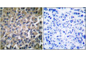 Immunohistochemical analysis of paraffin-embedded human breast carcinoma tissue using GRP78 antibody. (GRP78 抗体)