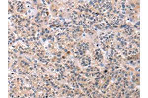The image on the left is immunohistochemistry of paraffin-embedded Human liver cancer tissue using ABIN7192749(TCERG1L Antibody) at dilution 1/30, on the right is treated with synthetic peptide. (TCERG1L 抗体)