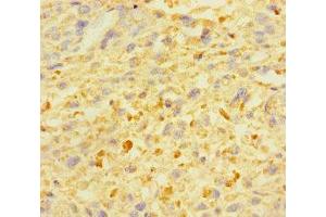 Immunohistochemistry of paraffin-embedded human melanoma using ABIN7176008 at dilution of 1:100 (ZSCAN29 抗体  (AA 1-300))