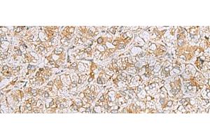 Immunohistochemistry of paraffin-embedded Human liver cancer tissue using FERMT1 Polyclonal Antibody at dilution of 1:30(x200) (FERMT1 抗体)