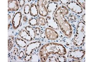 Immunohistochemical staining of paraffin-embedded Carcinoma of liver tissue using anti-BTK mouse monoclonal antibody. (BTK 抗体)