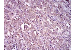 Immunohistochemical analysis of paraffin-embedded cervical cancer tissues using ITGA2B mouse mAb with DAB staining. (Integrin Alpha2b 抗体  (AA 45-149))