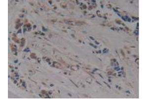 IHC-P analysis of Human Breast Cancer Tissue, with DAB staining. (MAPT 抗体  (AA 130-386))