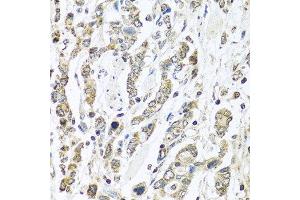 Immunohistochemistry of paraffin-embedded human gastric cancer using IFNL3 antibody at dilution of 1:100 (40x lens). (IL28B 抗体)
