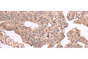 Immunohistochemistry of paraffin-embedded Human colorectal cancer tissue using MAGEC2 Polyclonal Antibody at dilution of 1:60(x200) (MAGEC2 抗体)