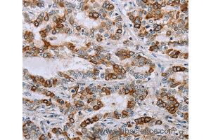 Immunohistochemistry of Human cervical cancer using NMT1 Polyclonal Antibody at dilution of 1:45 (NMT1 抗体)