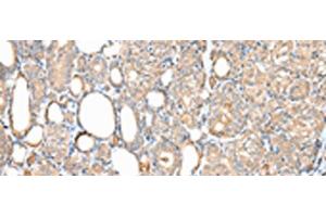 Immunohistochemistry of paraffin-embedded Human thyroid cancer tissue using DPH7 Polyclonal Antibody at dilution of 1:40(x200) (Diphthamide Biosynthesis 7 (DPH7) 抗体)