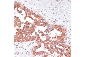Immunohistochemistry of paraffin-embedded Human mammary cancer using PGD antibody (ABIN6127314, ABIN6145502, ABIN6145503 and ABIN6223639) at dilution of 1:100 (40x lens). (PGD 抗体  (AA 184-483))