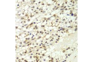 Immunohistochemistry of paraffin-embedded human kidney cancer using LHX4 antibody (ABIN5975324) at dilution of 1/100 (40x lens). (LHX4 抗体)