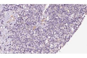 ABIN6273176 at 1/100 staining Human lymph cancer tissue by IHC-P. (TIMM44 抗体  (N-Term))
