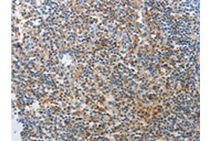 The image on the left is immunohistochemistry of paraffin-embedded Human tonsil tissue using ABIN7189642(AD7C-NTP Antibody) at dilution 1/25, on the right is treated with synthetic peptide. (AD7C-NTP 抗体)