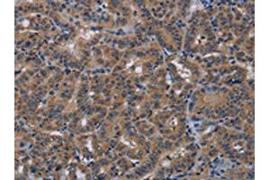 The image on the left is immunohistochemistry of paraffin-embedded Human thyroid cancer tissue using ABIN7191819(PDE4A Antibody) at dilution 1/40, on the right is treated with synthetic peptide. (PDE4A 抗体)