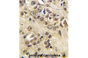 Formalin-fixed and paraffin-embedded human prostate carcinoma tissue reacted with MYC polyclonal antibody  , which was peroxidase-conjugated to the secondary antibody, followed by DAB staining. (c-MYC 抗体  (Thr58))
