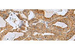 Immunohistochemistry of paraffin-embedded Human thyroid cancer tissue using RPL10A Polyclonal Antibody at dilution of 1:50(x200) (RPL10A 抗体)