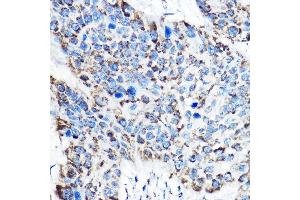 Immunohistochemistry of paraffin-embedded human esophageal cancer using OAT Rabbit pAb (ABIN6127442, ABIN6144985, ABIN6144986 and ABIN6221831) at dilution of 1:150 (40x lens). (OAT 抗体  (AA 160-439))