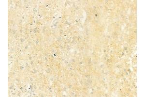 ABIN6264564 and ABIN6279731 at 1/100 staining human glioblastoma by IHC-P.