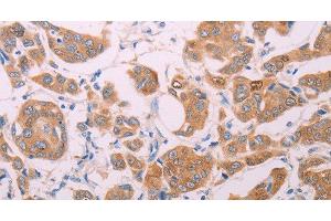 Immunohistochemistry of paraffin-embedded Human breast cancer using AGT Polyclonal Antibody at dilution of 1:30 (AGT 抗体)