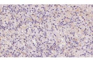 ABIN6273084 at 1/100 staining Human lymph cancer tissue by IHC-P. (UQCRFS1 抗体  (C-Term))