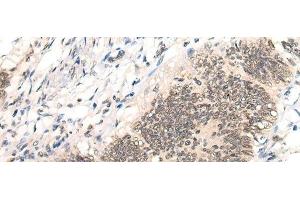 Immunohistochemistry of paraffin-embedded Human colorectal cancer tissue using AURKA Polyclonal Antibody at dilution of 1:40(x200) (Aurora A 抗体)