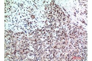 Immunohistochemistry (IHC) analysis of paraffin-embedded Human Breast Cancer, antibody was diluted at 1:200. (TP53INP2 抗体)