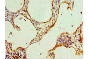 Immunohistochemistry of paraffin-embedded human cervical cancer using ABIN7155200 at dilution of 1:100 (HMGN4 抗体  (AA 1-90))