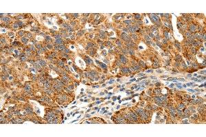 Immunohistochemistry of paraffin-embedded Human ovarian cancer using SSTR1 Polyclonal Antibody at dilution of 1:40 (SSTR1 抗体)