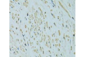 Immunohistochemistry of paraffin-embedded Human uterine cancer using UGT1A6 Polyclonal Antibody at dilution of 1:100 (40x lens). (UGT1A6 抗体)