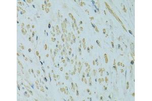 Immunohistochemistry of paraffin-embedded Human uterine cancer using UGT1A6 Polyclonal Antibody at dilution of 1:100 (40x lens). (UGT1A6 抗体)