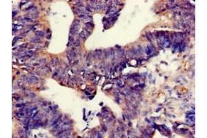 Immunohistochemistry of paraffin-embedded human colon cancer using ABIN7172340 at dilution of 1:100 (TNIK 抗体  (AA 523-714))