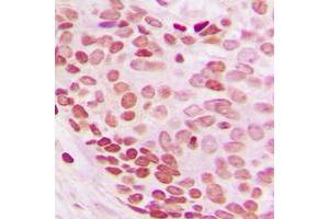 Immunohistochemical analysis of NEDD8 staining in human breast cancer formalin fixed paraffin embedded tissue section. (NEDD8 抗体  (N-Term))