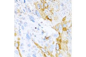 Immunohistochemistry of paraffin-embedded mouse esophageal cancer using SPINT1 antibody (ABIN5973812) at dilution of 1/100 (40x lens). (SPINT1 抗体)