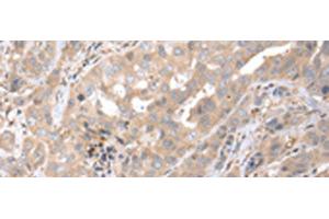 Immunohistochemistry of paraffin-embedded Human breast cancer tissue using PPBP Polyclonal Antibody at dilution of 1:35(x200) (CXCL7 抗体)