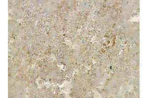 ABIN6260261 and ABIN6269348 at 1/100 staining human melanoma by IHC-P. (BIK 抗体  (N-Term))