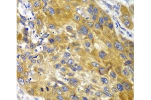 Immunohistochemistry of paraffin-embedded Human esophageal cancer using AK1 Polyclonal Antibody at dilution of 1:100 (40x lens). (Adenylate Kinase 1 抗体)