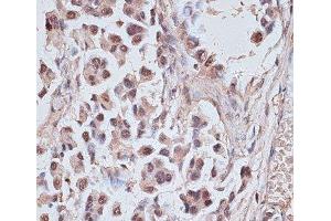 Immunohistochemistry of paraffin-embedded Human lung cancer using NR5A2 Polyclonal Antibody at dilution of 1:100 (40x lens). (NR5A2 + LRH1 抗体)