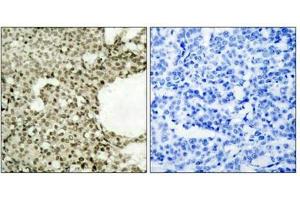 Immunohistochemical analysis of paraffin-embedded human breast carcinoma tissue using STAT1(Phospho-Ser727) Antibody(left) or the same antibody preincubated with blocking peptide(right). (STAT1 抗体  (pSer727))