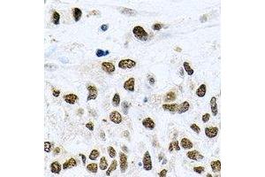 Immunohistochemical analysis of NELF-E staining in human lung cancer formalin fixed paraffin embedded tissue section. (RDBP 抗体)