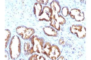 Formalin-fixed, paraffin-embedded human Prostate Carcinoma stained with PSAP Monoclonal Antibody (PASE/4LJ). (ACPP 抗体)