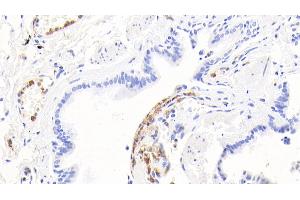 Detection of CALPRO in Human Lung Tissue using Polyclonal Antibody to Calprotectin (CALPRO) (S100A8/A9 Complex (Calprotectin) 抗体  (AA 1-114))