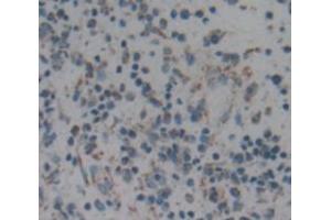 IHC-P analysis of liver cancer tissue, with DAB staining. (ARPC2 抗体  (AA 1-300))