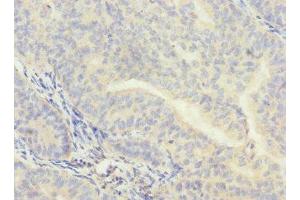 Immunohistochemistry of paraffin-embedded human endometrial cancer using ABIN7147920 at dilution of 1:100 (CPSF4 抗体  (AA 1-244))