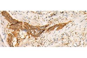 Immunohistochemistry of paraffin-embedded Human esophagus cancer tissue using SMUG1 Polyclonal Antibody at dilution of 1:50(x200) (SMUG1 抗体)