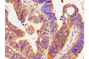 Immunohistochemistry of paraffin-embedded human colon cancer using ABIN7170044 at dilution of 1:100 (ATP1B1 抗体  (AA 64-241))