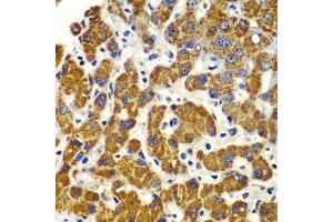 Immunohistochemistry of paraffin-embedded human liver injury using SMAD9 antibody (ABIN5975592) at dilution of 1/100 (40x lens). (SMAD9 抗体)