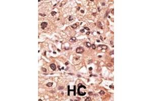 Formalin-fixed and paraffin-embedded human cancer tissue reacted with the primary antibody, which was peroxidase-conjugated to the secondary antibody, followed by AEC staining. (MAGEF1 抗体  (C-Term))