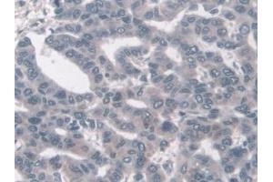 Detection of KLC1 in Human Liver cancer Tissue using Polyclonal Antibody to Kinesin Light Chain 1 (KLC1) (KLC1 抗体  (AA 1-254))